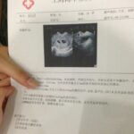 19岁少女做人流前上网晒图：舍不得这对双胞胎